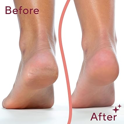 مزيلات مسامير القدم الكهربائية | Electric Feet Callus Removers